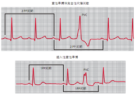 心律失常:心电图分析的两个关键步骤】-中华医