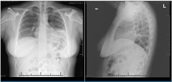 胸片显示左肺下叶致密实变影