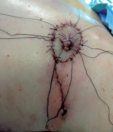 男性乳房手术图片
