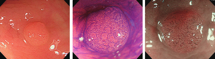直肠管状腺瘤是什么图片